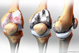 Artrosis o gonartrosis de rodilla. Síntomas y tratamiento
